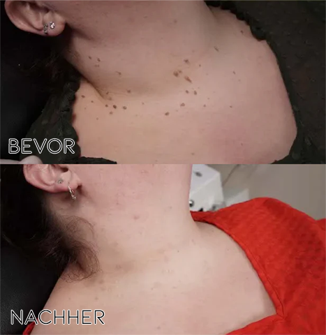 1+1 GRATIS | BeeNaturale™ Schmerzfreie Hauterneuerung