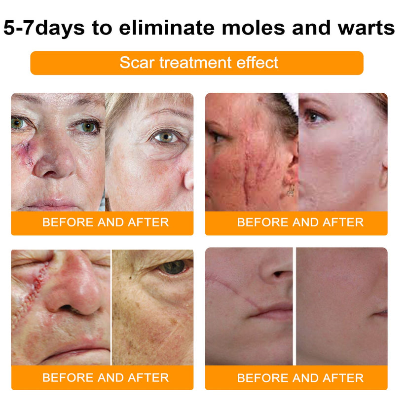 NEWYOU TagLift Creme | Bienengift Hautbehandlung | Schmerzfreie Warzen- & Muttermalentfernung | 1+1 Gratis