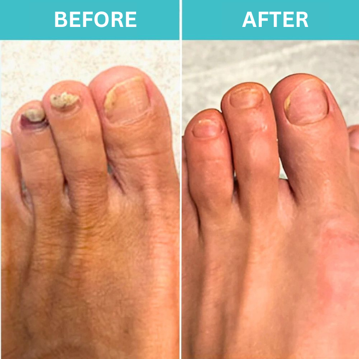 50% OFF TEMPORÄR | FungiZap™