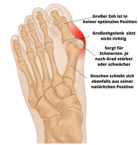 Flex-Ballenzehkorrektor - Rette deinen Zeh bevor es zu spät ist!