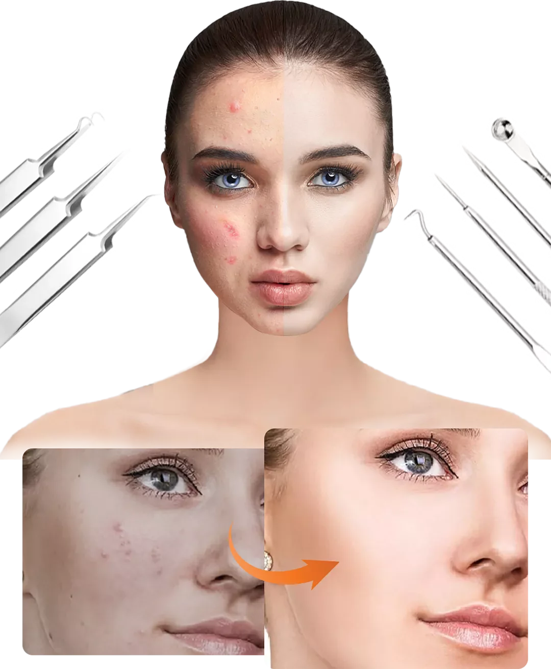 DermaTool™ – Präzise Entfernung von Mitessern