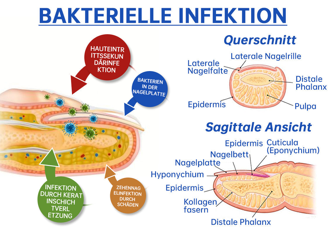 NailCure™ - Nagelpilz-Laserbehandlung Lösung (50% RABATT)