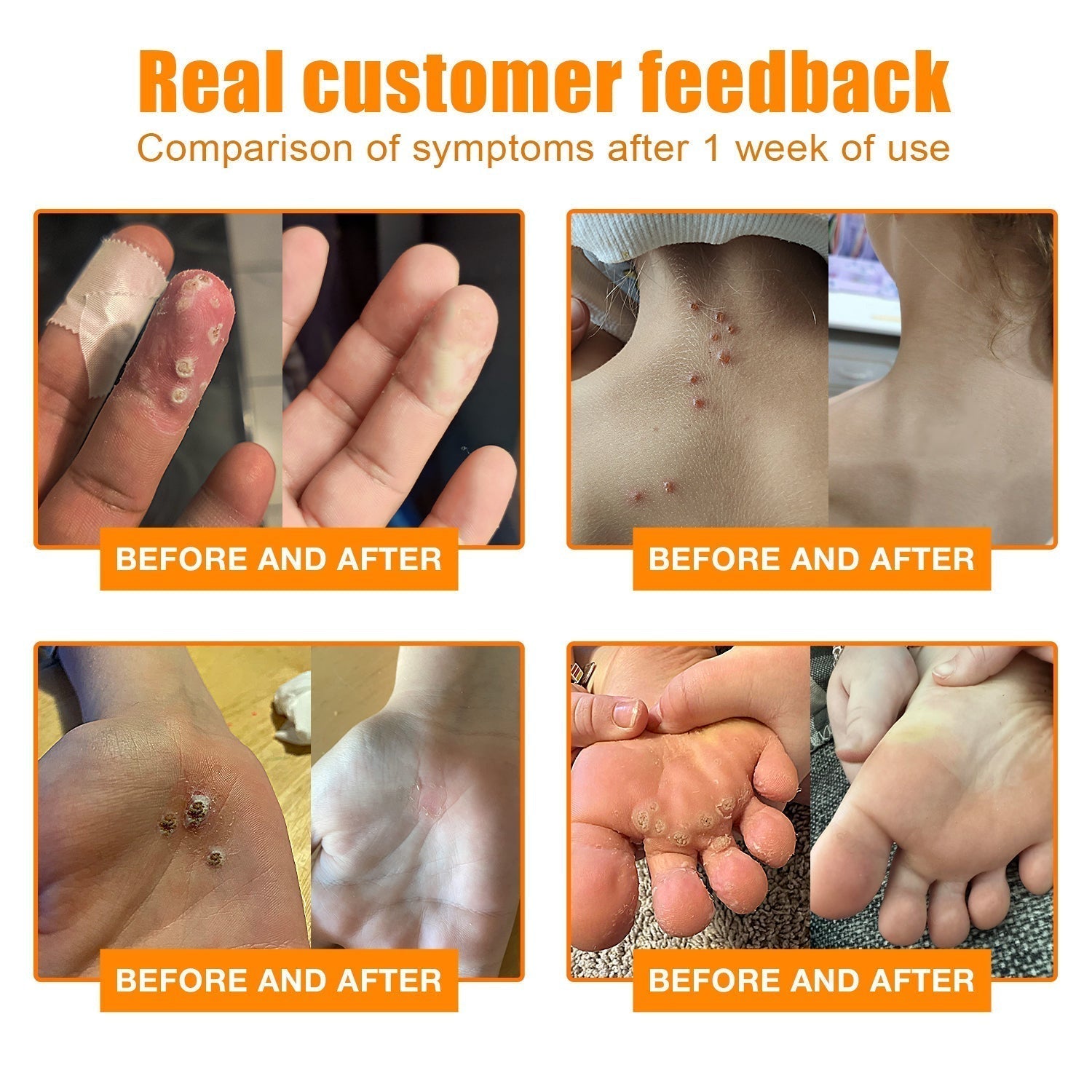 NEWYOU TagLift Creme | Bienengift Hautbehandlung | Schmerzfreie Warzen- & Muttermalentfernung | 1+1 Gratis