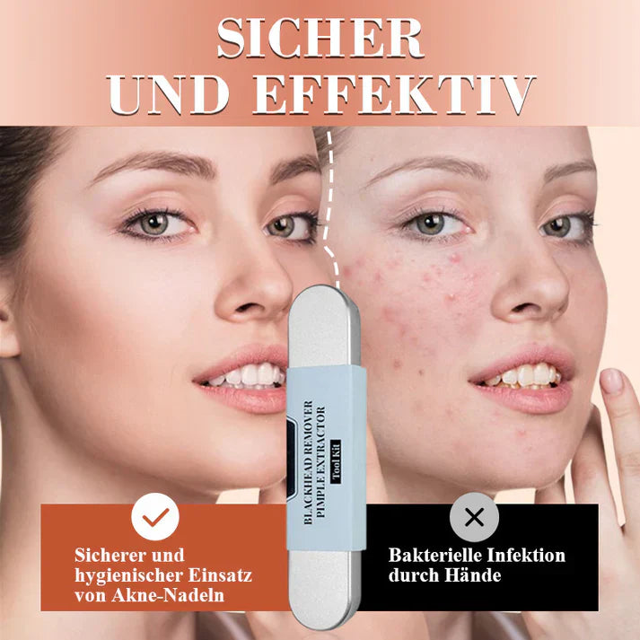 DermaTool™ – Präzise Entfernung von Mitessern