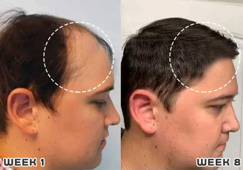 1+1 GRATIS | Haarwuchs Roll-On | Mit Minoxidil, Biotin & Glycerin | Gegen Haarausfall | Praktische Anwendung |GlowMane™