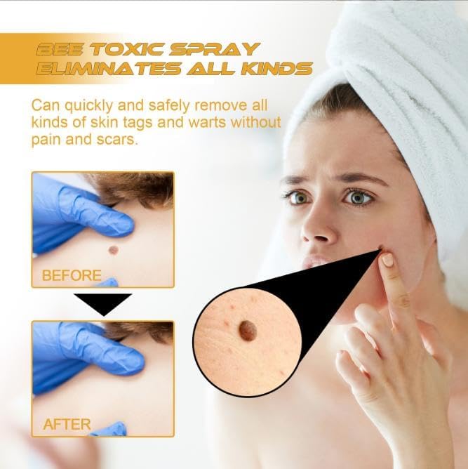 TagAway Warzen Entferner | Bienengift Formel | Effektiv & Schonend | 1+1 Gratis