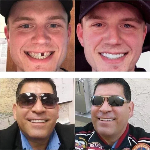 SchnellesEinrasten™ | Einstellbare Snap-On-Prothese | Natürliches Lächeln ohne Zahnarztbesuch