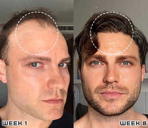 1+1 GRATIS | Haarwuchs Roll-On | Mit Minoxidil, Biotin & Glycerin | Gegen Haarausfall | Praktische Anwendung |GlowMane™