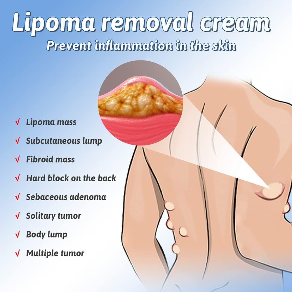 LipoGone Lipom Creme | Natürliche Entfernung von Lipomen & Knoten | Schmerzfrei | 1+1 Gratis