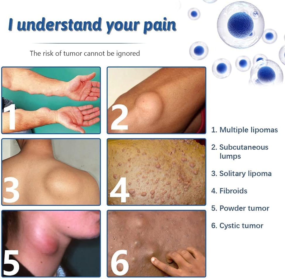 LipoGone Lipom Creme | Natürliche Entfernung von Lipomen & Knoten | Schmerzfrei | 1+1 Gratis