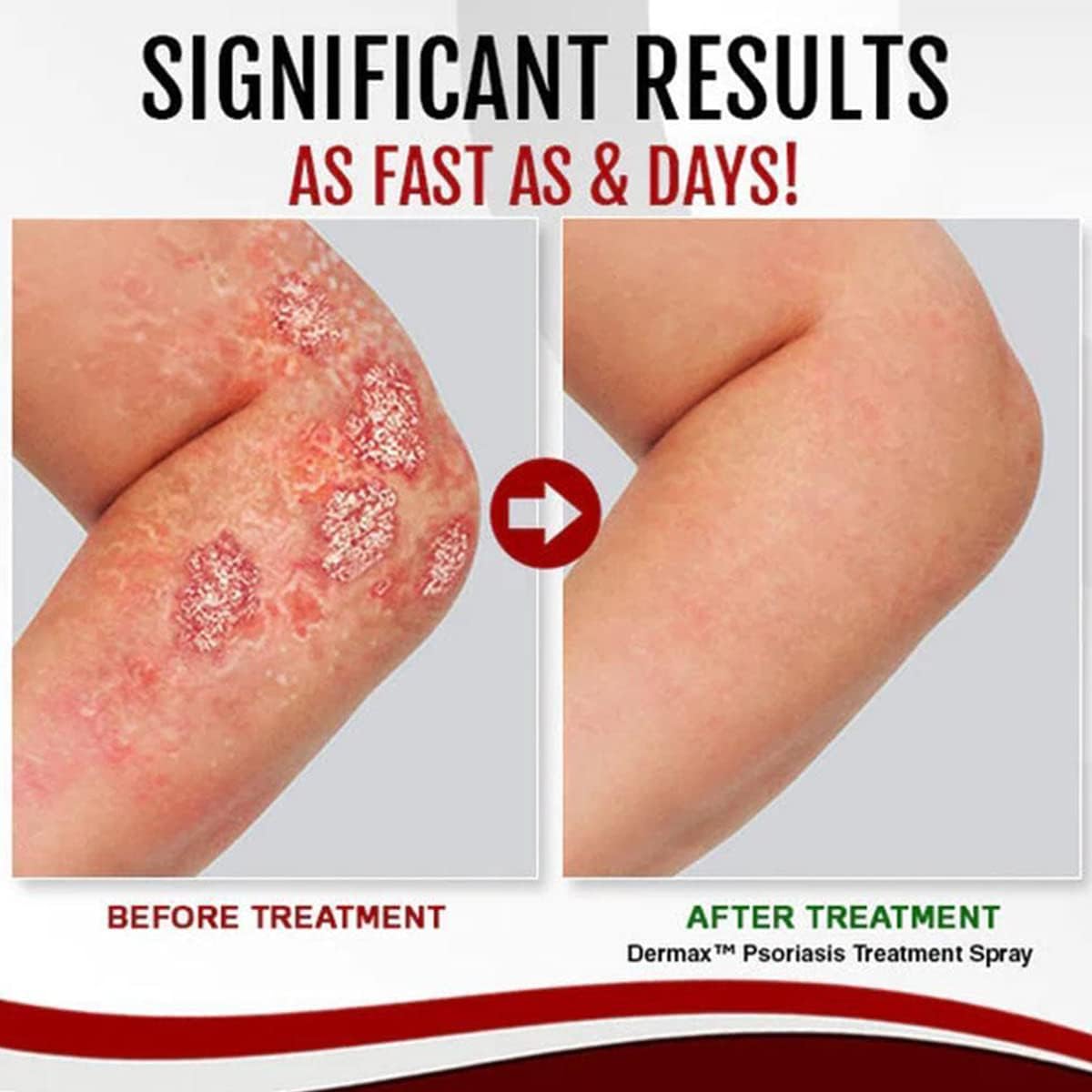 PsoriSpray™ | Spray gegen Schuppenflechte | Schnelle Linderung | 1+1 Gratis