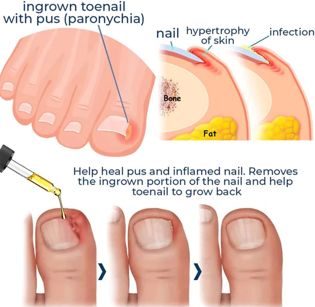 1+1 Gratis | HealNail™ Reparatur beschädigter Nägel in 4 Wochen
