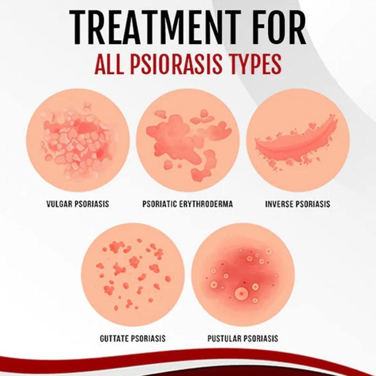 PsoriSpray™ | Spray gegen Schuppenflechte | Schnelle Linderung | 1+1 Gratis