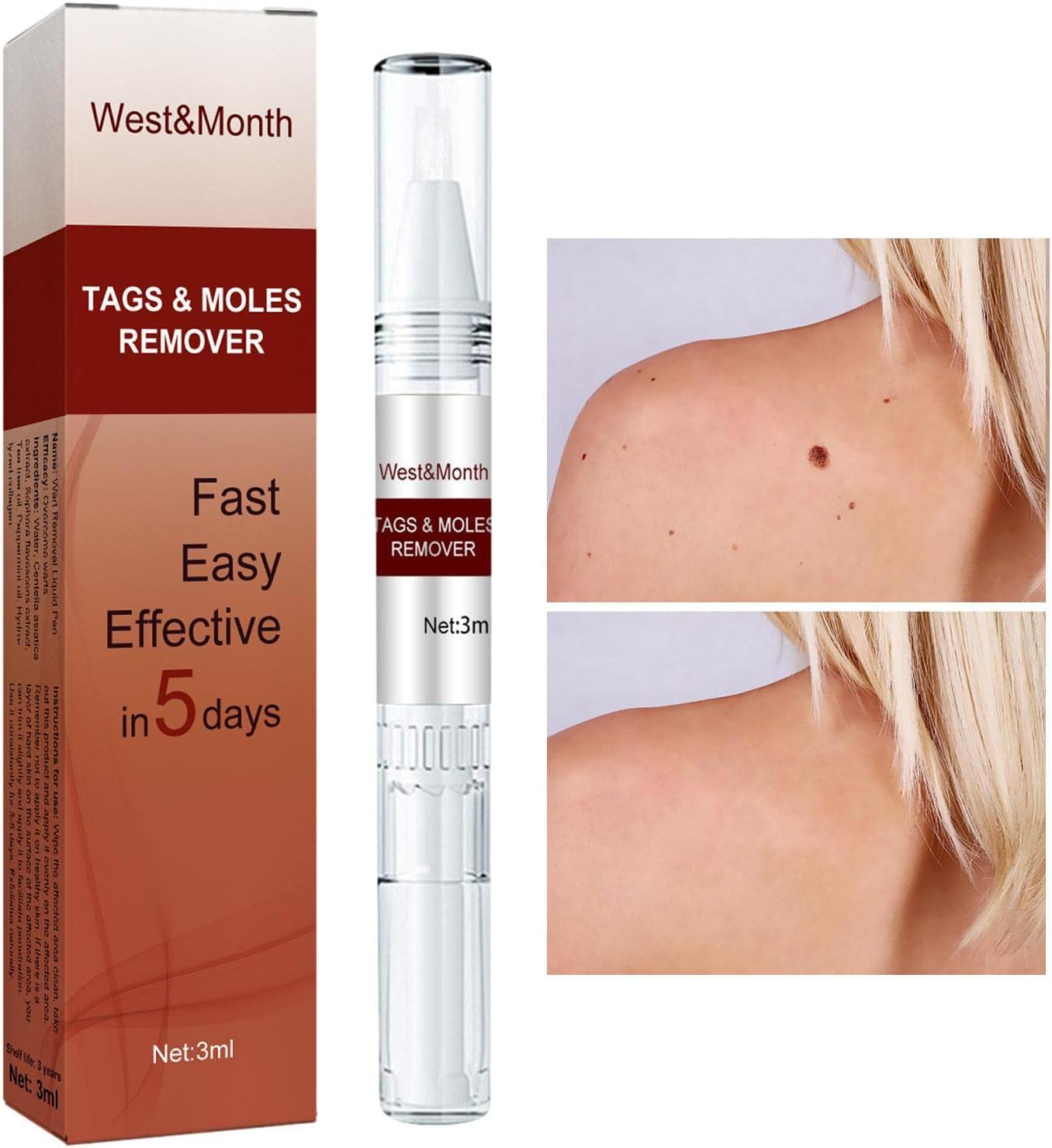 1+1 Gratis | SkinFix™ Sanfter Hautunreinheiten- und Muttermalentferner