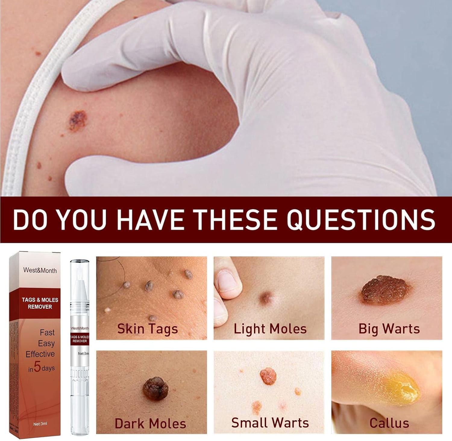 1+1 Gratis | SkinFix™ Sanfter Hautunreinheiten- und Muttermalentferner