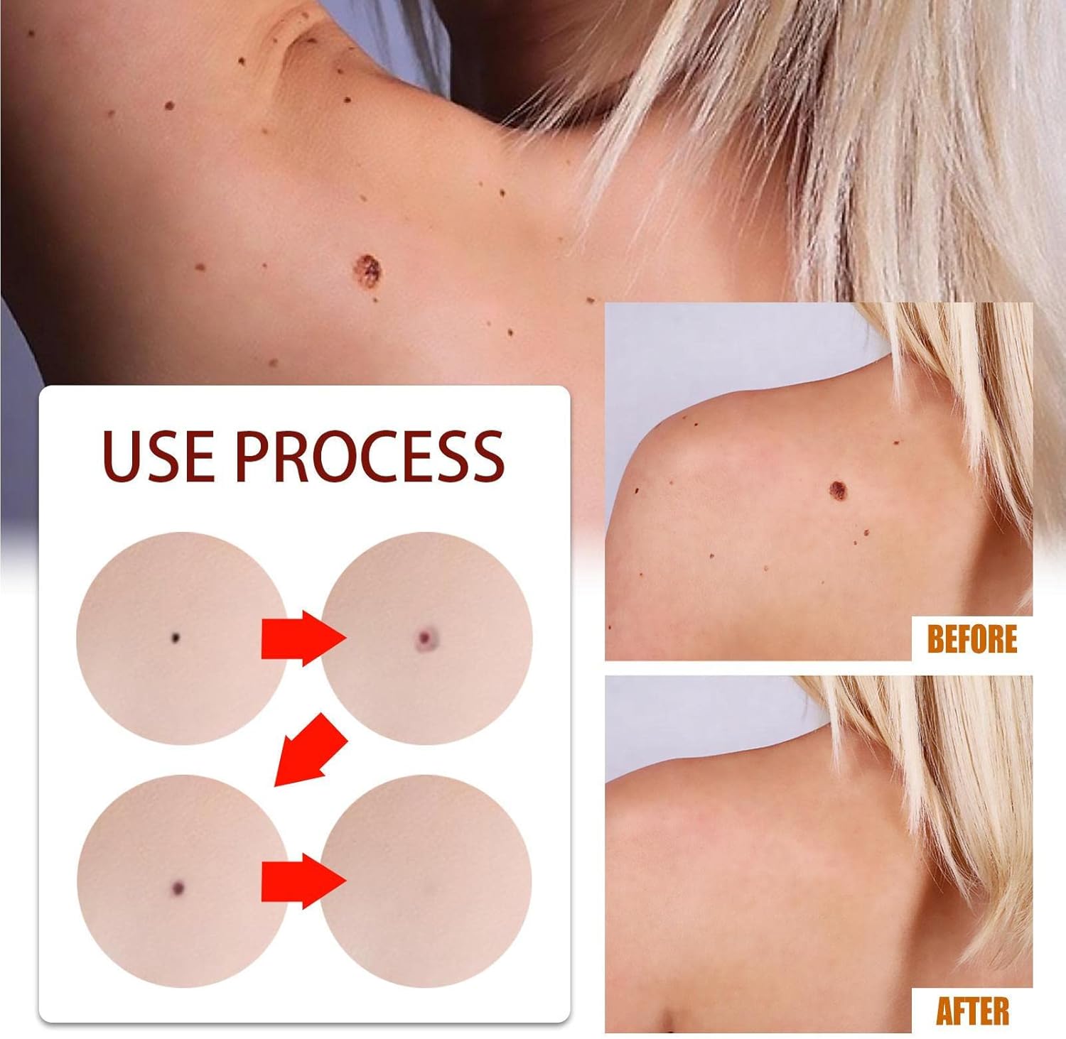 1+1 Gratis | SkinFix™ Sanfter Hautunreinheiten- und Muttermalentferner