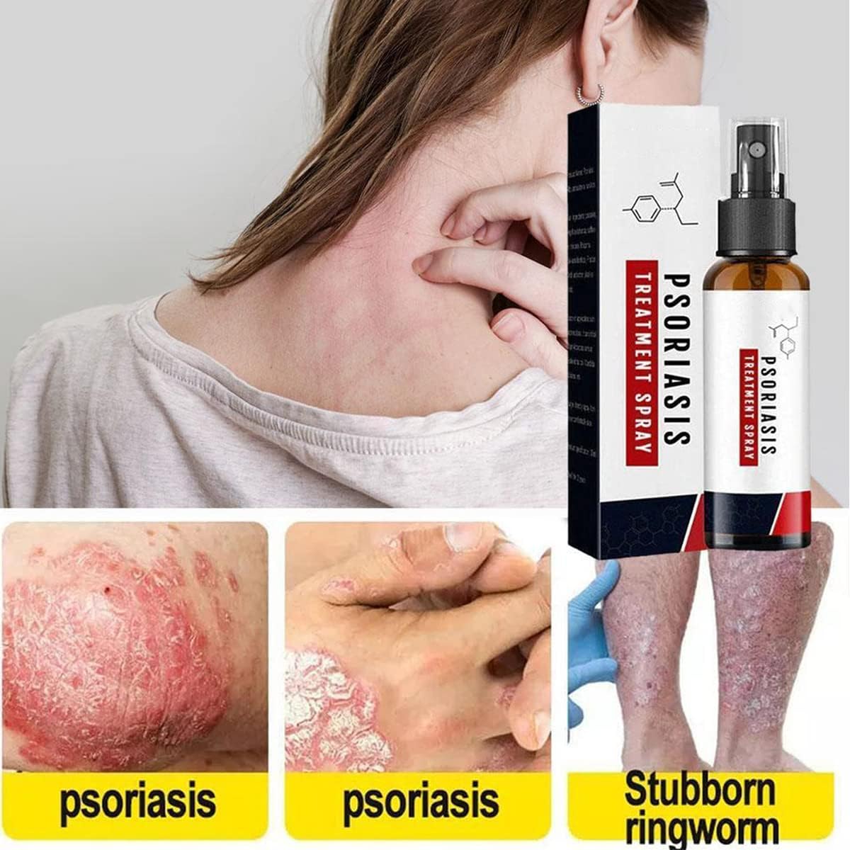 PsoriSpray™ | Spray gegen Schuppenflechte | Schnelle Linderung | 1+1 Gratis