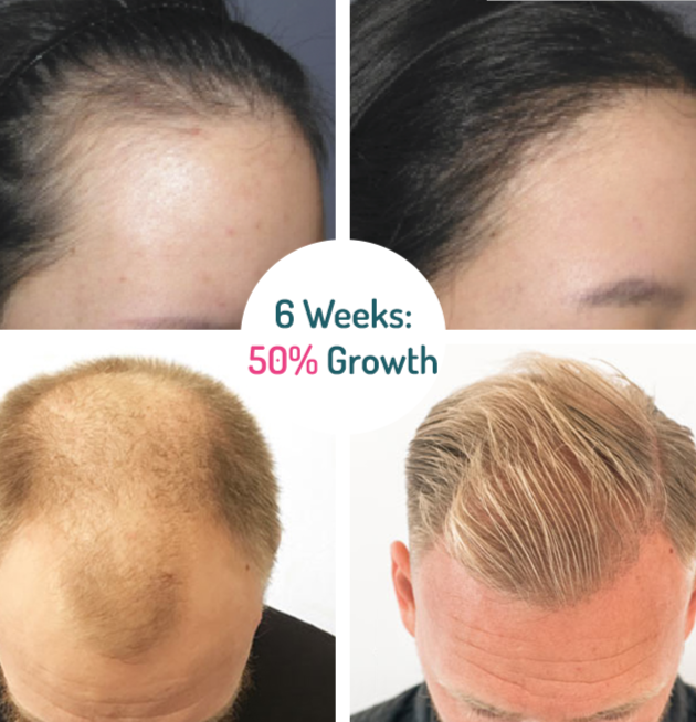 Growhair™ Haarwuchs-Serum Roll-on | 1+1 Gratis | Dichtes & Gesundes Haar