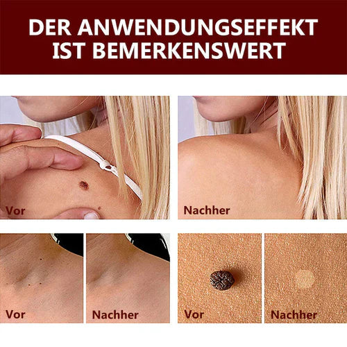 HautKlar™ Tags & Maulwurfsentferner