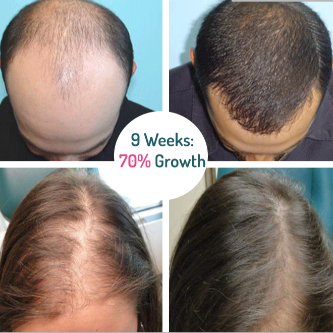 Growhair™ Haarwuchs-Serum Roll-on | 1+1 Gratis | Dichtes & Gesundes Haar