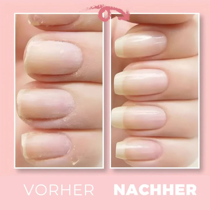 1+1 Gratis | NailWonder™ Stärken Sie schwache Nägel und verhindern Sie mühelos Bruch