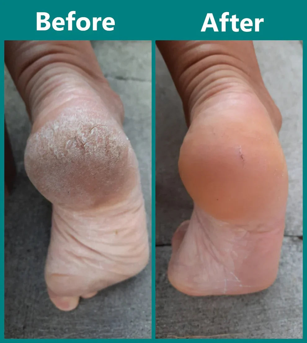 SoftTouch Fußerneuerer — Seidig glatte Füße im Handumdrehen