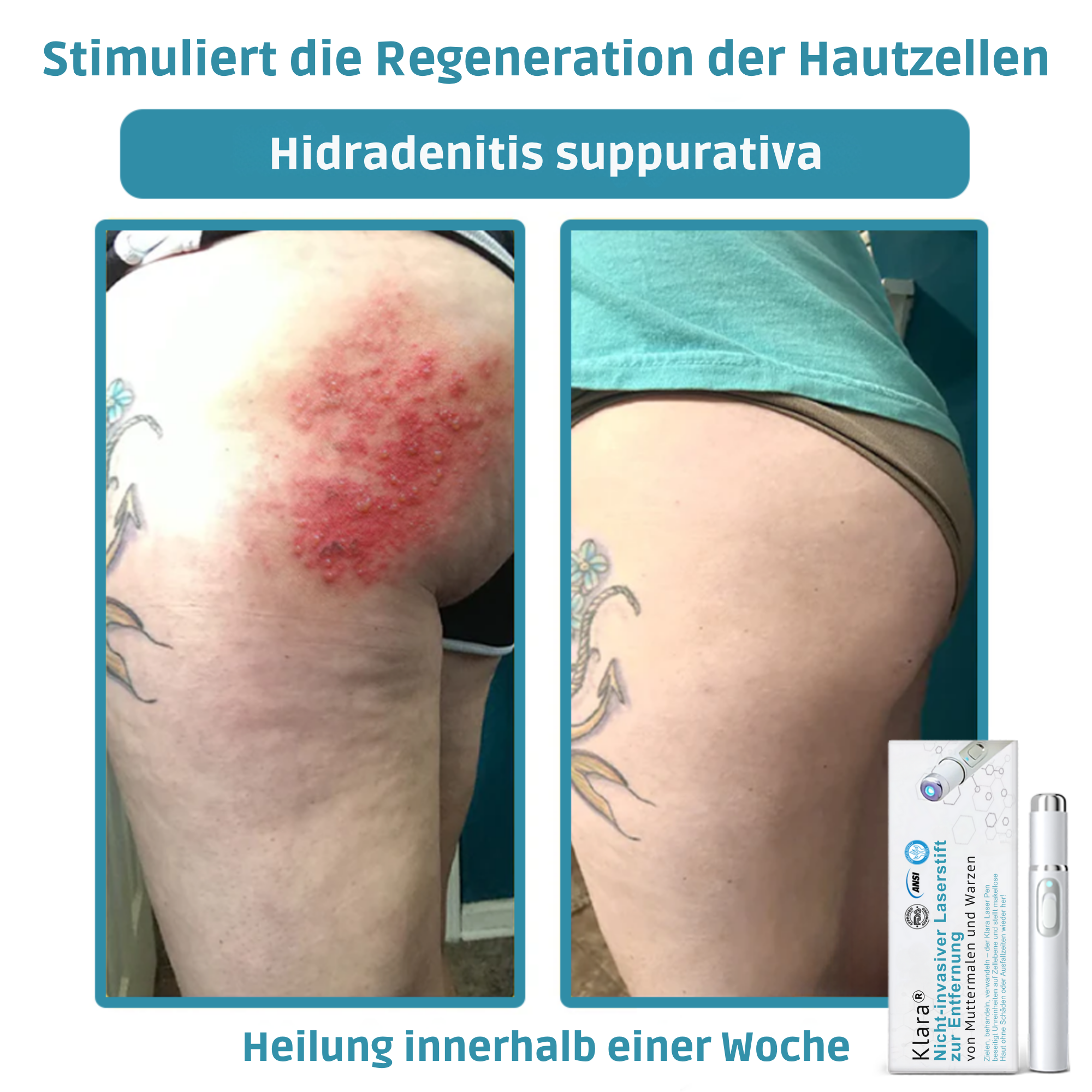 Klara™ Schmerzfreier Laser-Stift — Enthülle jederzeit makellose Haut und Selbstvertrauen