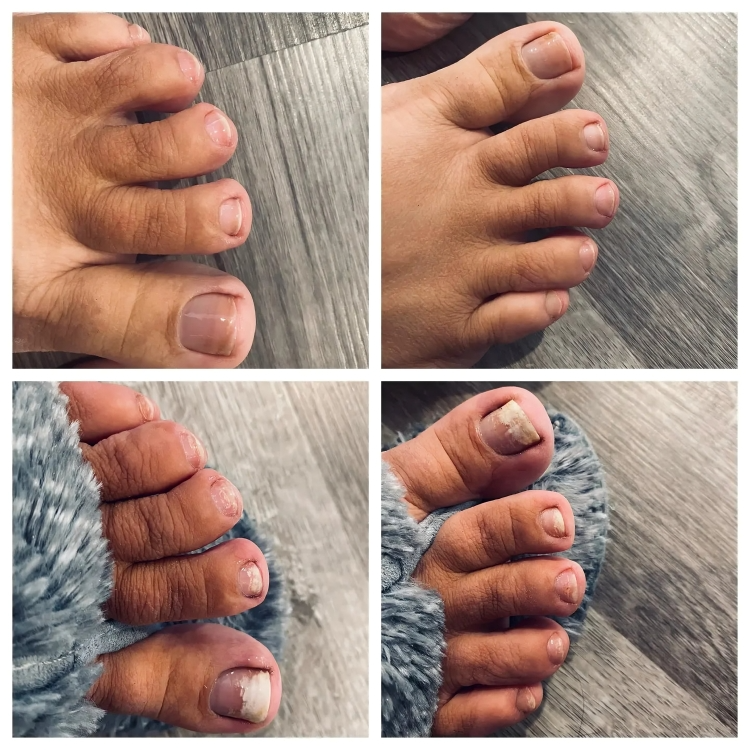 NailRenew™ | Nagelpilz bekämpfen und beseitigen!