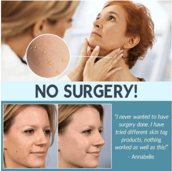 PatchEase™ Hautanhängsel Entferner Pflaster | Schmerzfrei & Natürlich | 1+1 Gratis