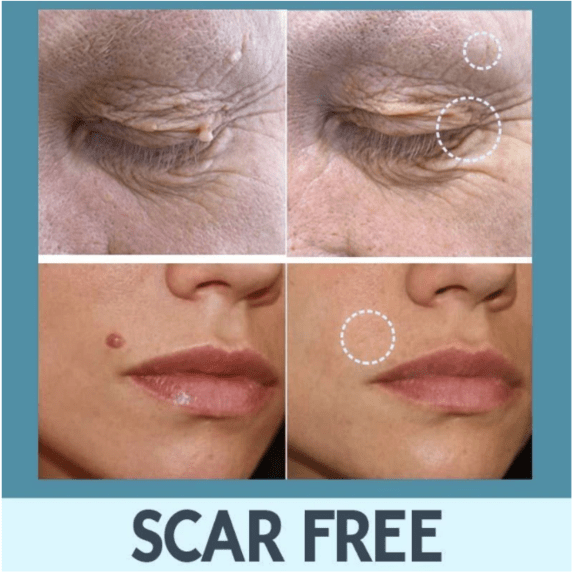 PatchEase™ Hautanhängsel Entferner Pflaster | Schmerzfrei & Natürlich | 1+1 Gratis