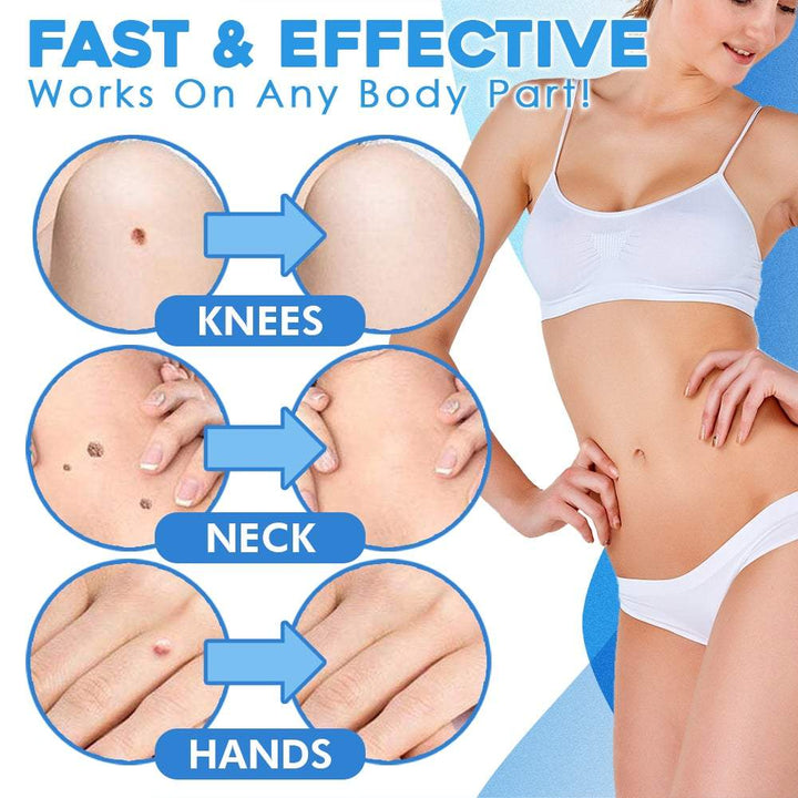 Tagton™ Warzenentferner | Schmerzfrei & Sicher | Für Zuhause