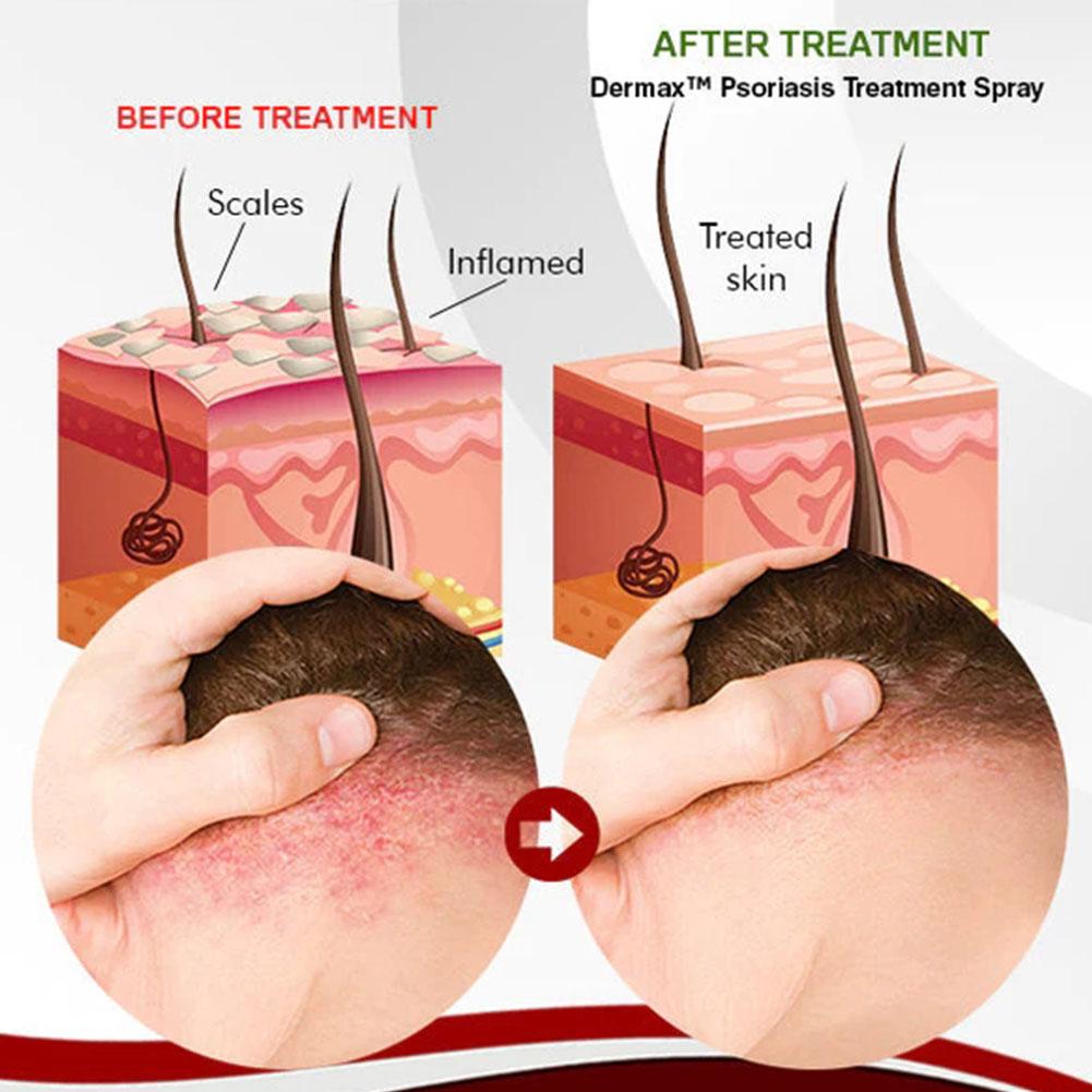Dermax™ Schuppenflechte-Spray