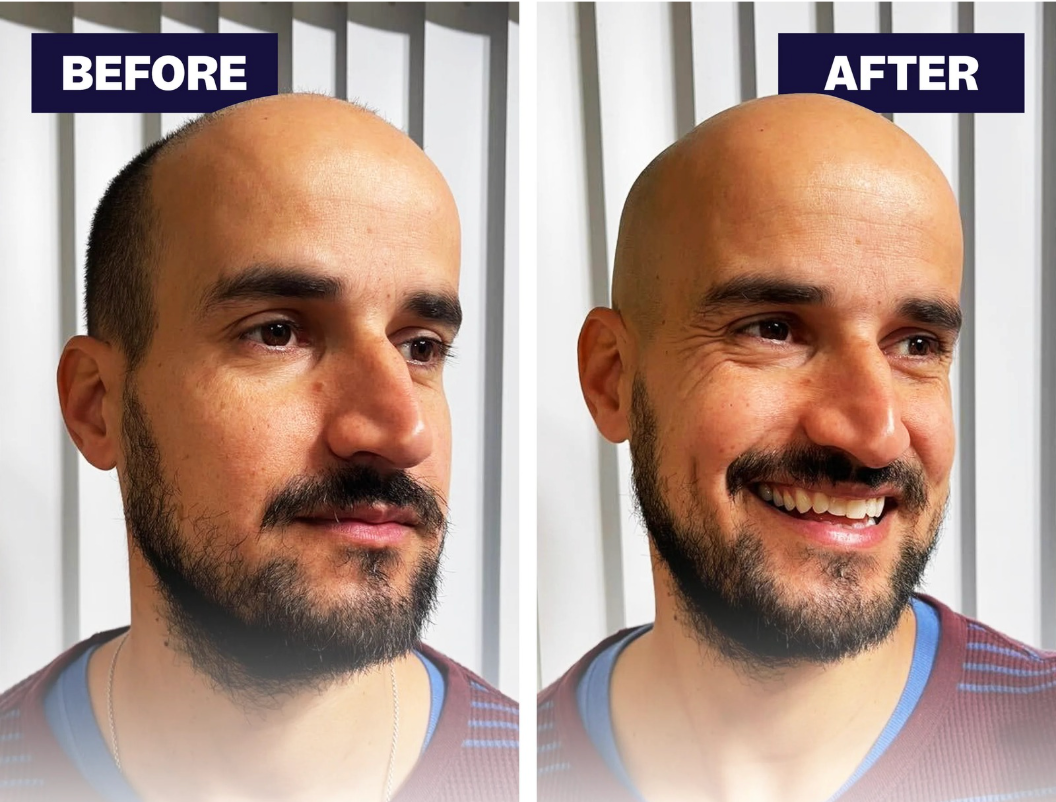 Mühelose Kopfrasur: Der unverzichtbare Rasierer für Glatzenträger