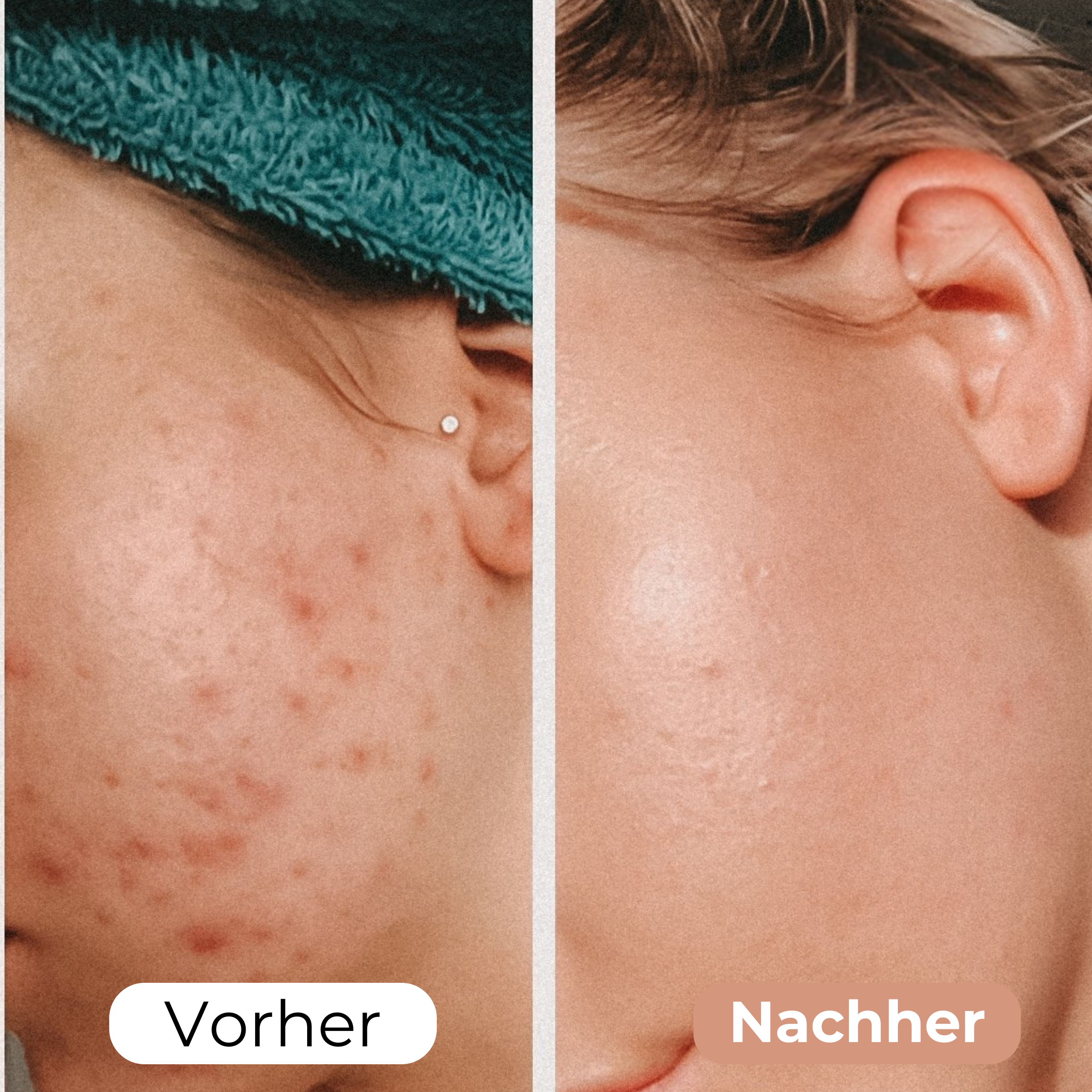 GoneWrinkle™ - Hydratisierte Faltenreduzierung