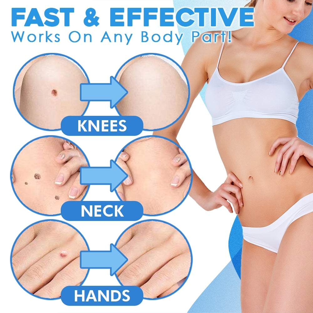 Skinna™ Hautanhängsel Entferner Kit | Schmerzfrei & Präzise | 1+1 Gratis