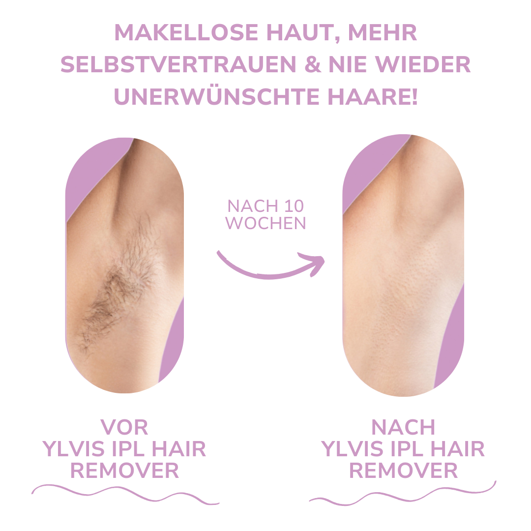 Ylvis IPL Hair Remover I Die führende Laser-Haarentfernung für Zuhause