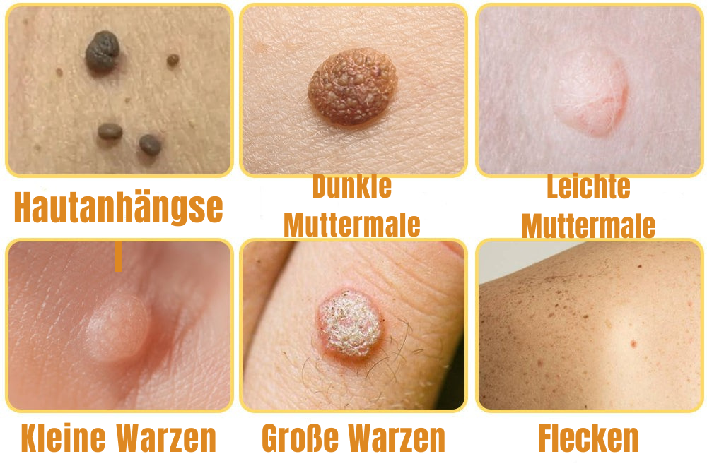 Warzen Spray | Bienengift Formel | Schmerzfrei