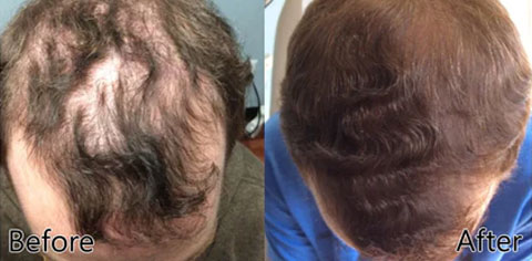 1+1 GRATIS | Haarwuchs Roll-On | Mit Minoxidil, Biotin & Glycerin | Gegen Haarausfall | Praktische Anwendung |GlowMane™