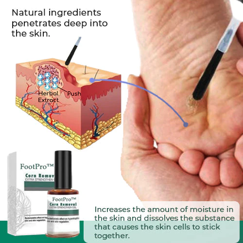 FootPro™ Hühneraugenentferner Gel | Extra Stark & Schmerzfrei | 1+1 Gratis