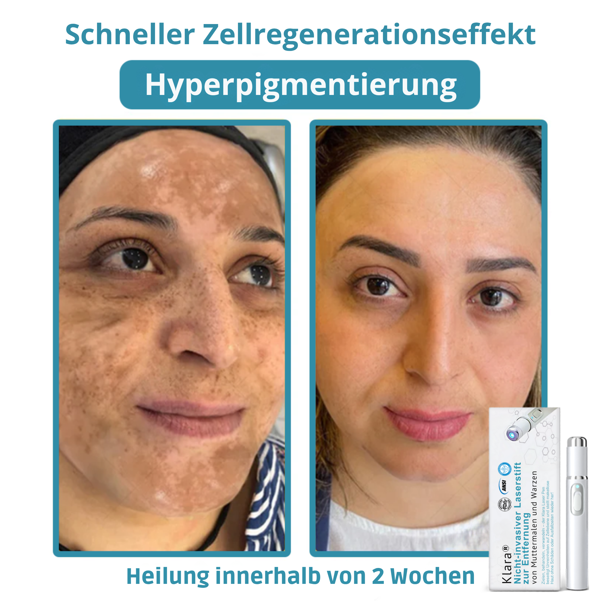 Klara™ Schmerzfreier Laser-Stift — Enthülle jederzeit makellose Haut und Selbstvertrauen