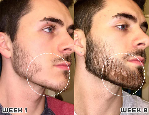 1+1 GRATIS | Haarwuchs Roll-On | Mit Minoxidil, Biotin & Glycerin | Gegen Haarausfall | Praktische Anwendung |GlowMane™