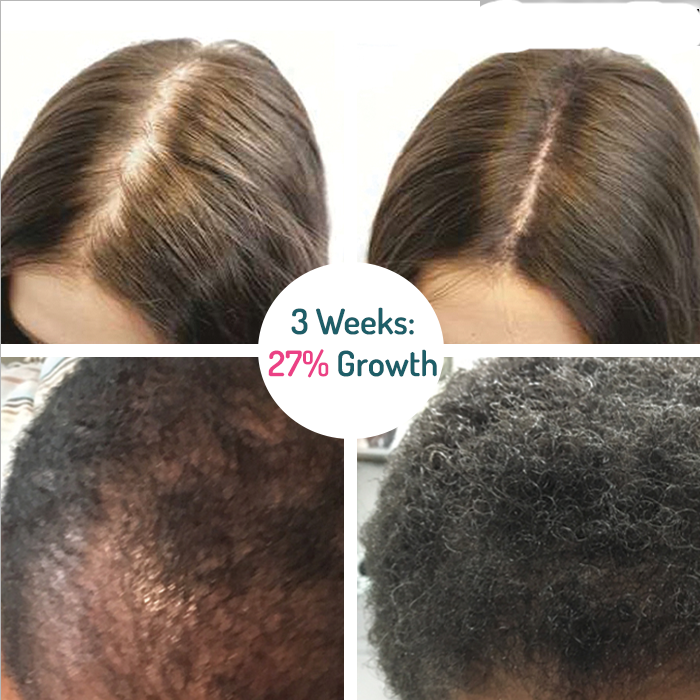 Growhair™ Haarwuchs-Serum Roll-on | 1+1 Gratis | Dichtes & Gesundes Haar