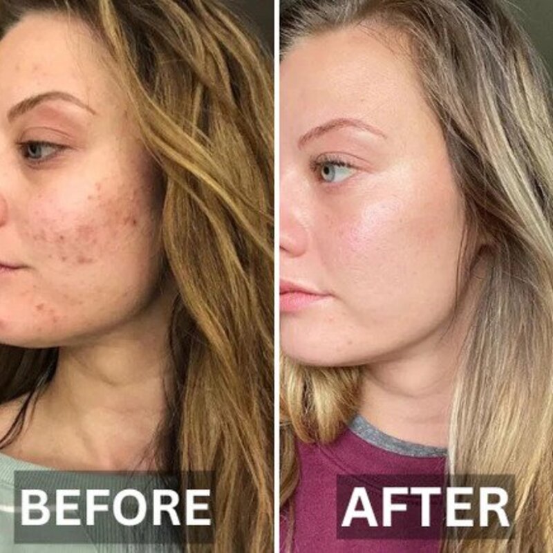 SkinRelief™ - Effektive Hautstraffung