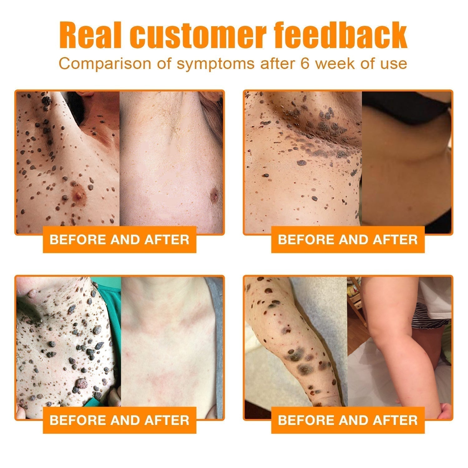 NEWYOU TagLift Creme | Bienengift Hautbehandlung | Schmerzfreie Warzen- & Muttermalentfernung | 1+1 Gratis