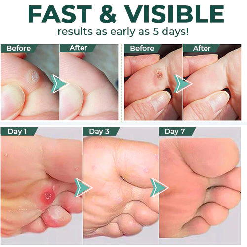 FootPro™ Hühneraugenentferner Gel | Extra Stark & Schmerzfrei | 1+1 Gratis