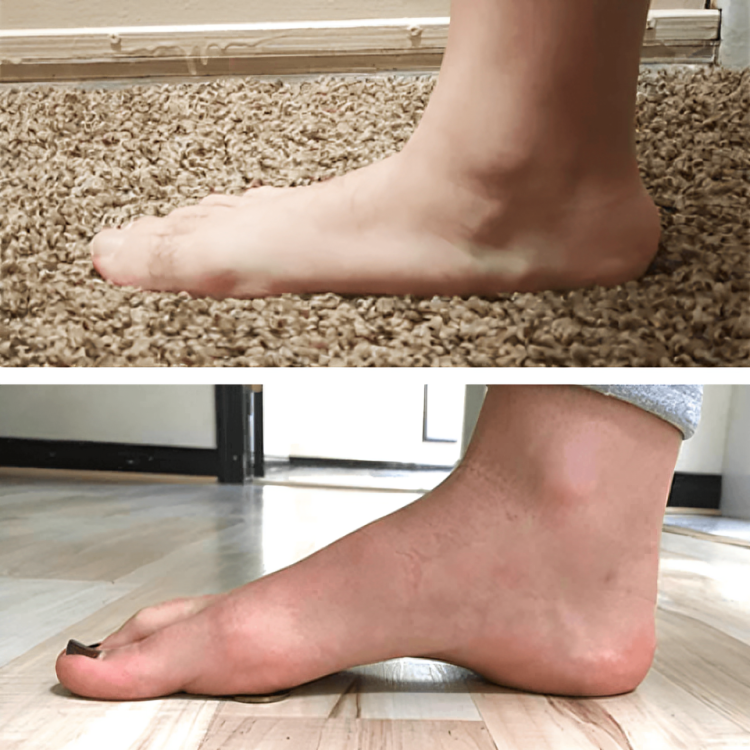 1+1 Gratis | Soleil™ Orthopädische Fußgewölbe-Unterstützung