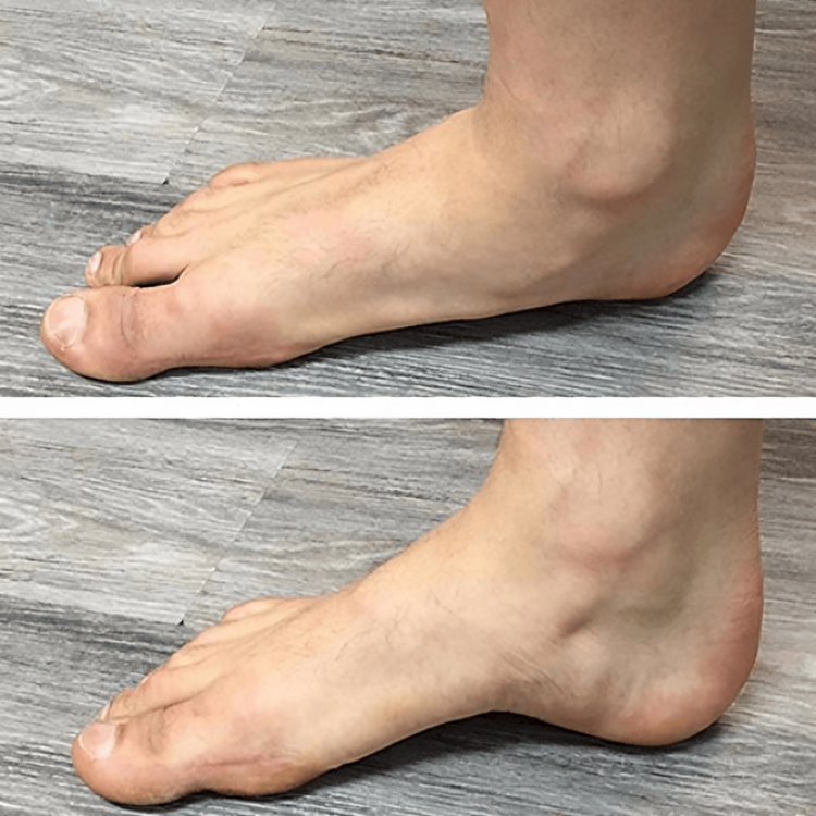 1+1 Gratis | Soleil™ Orthopädische Fußgewölbe-Unterstützung