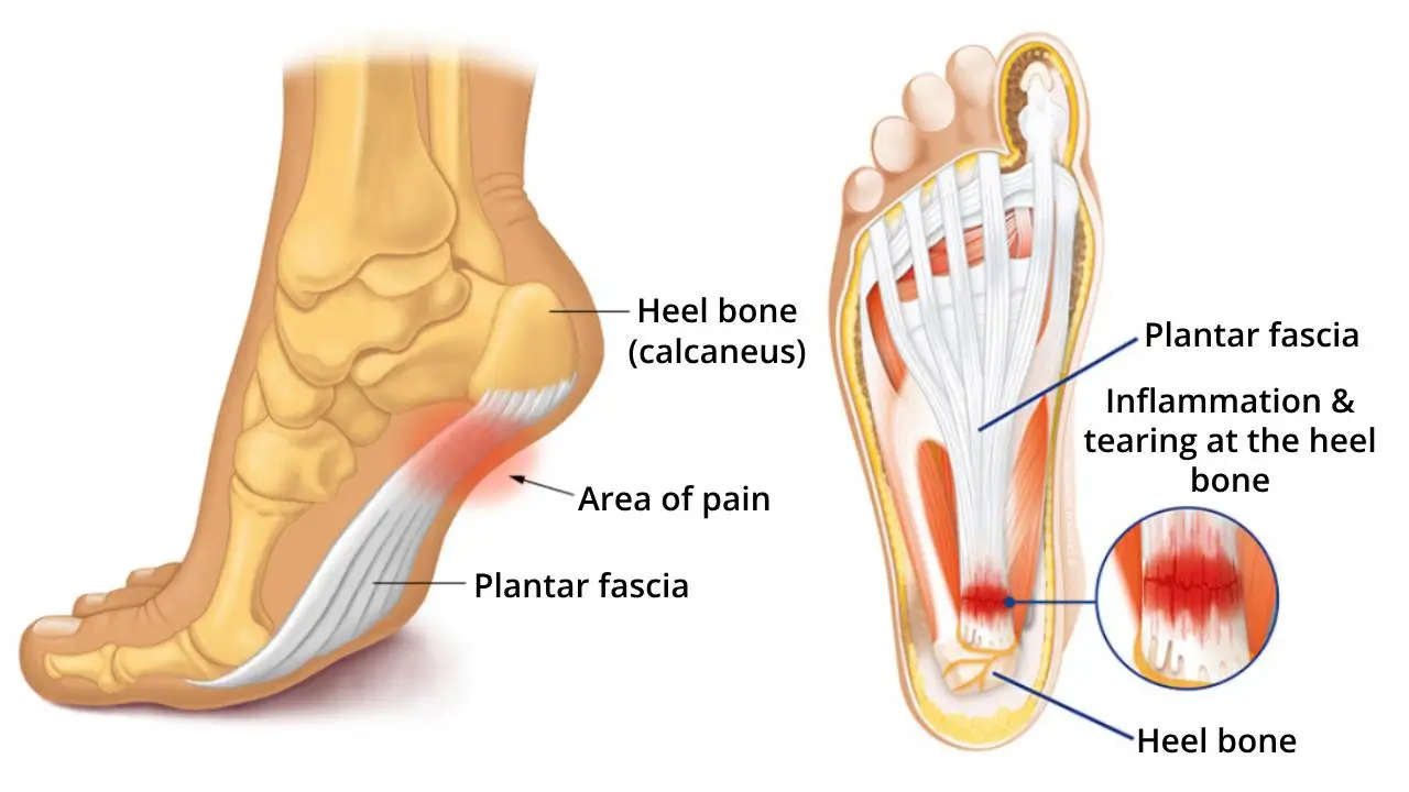 Revolutionäre orthopädische Einlegesohle