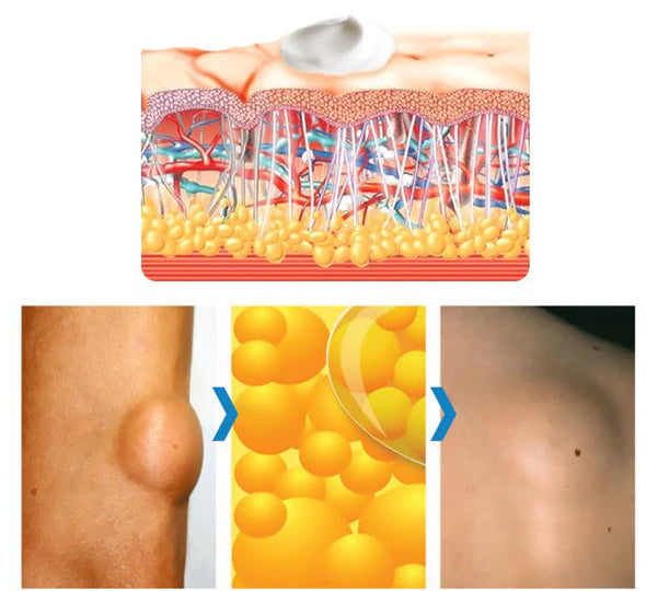 1+1 Gratis | LumpAway™ Lipom-Creme | Sanfte Entfernung | Kräuterforme