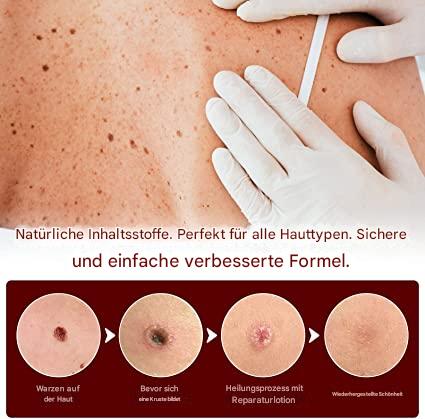 WartOff Hautflecken Entferner | Schmerzfrei | Natürliche Formel | 1+1 Gratis